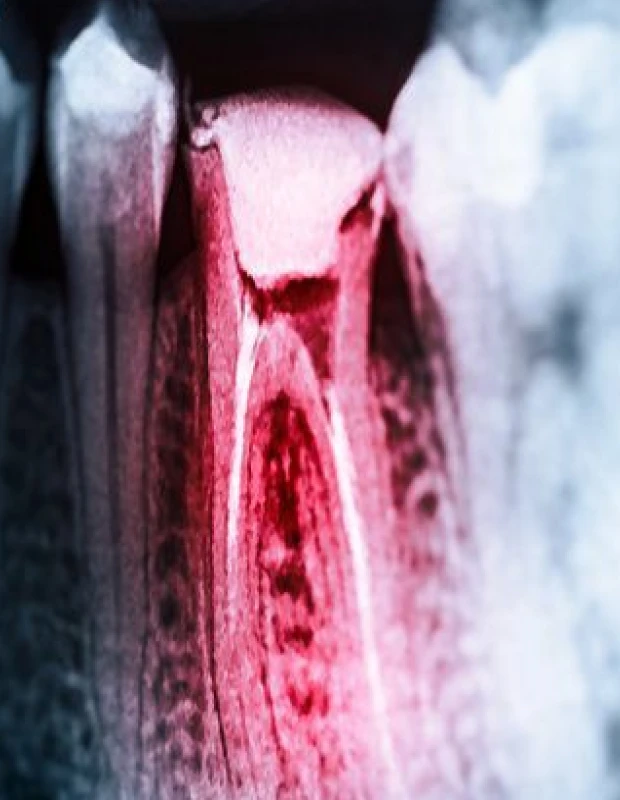 Cabinet dentaire A Murza à Furiani - Traitement endodontique